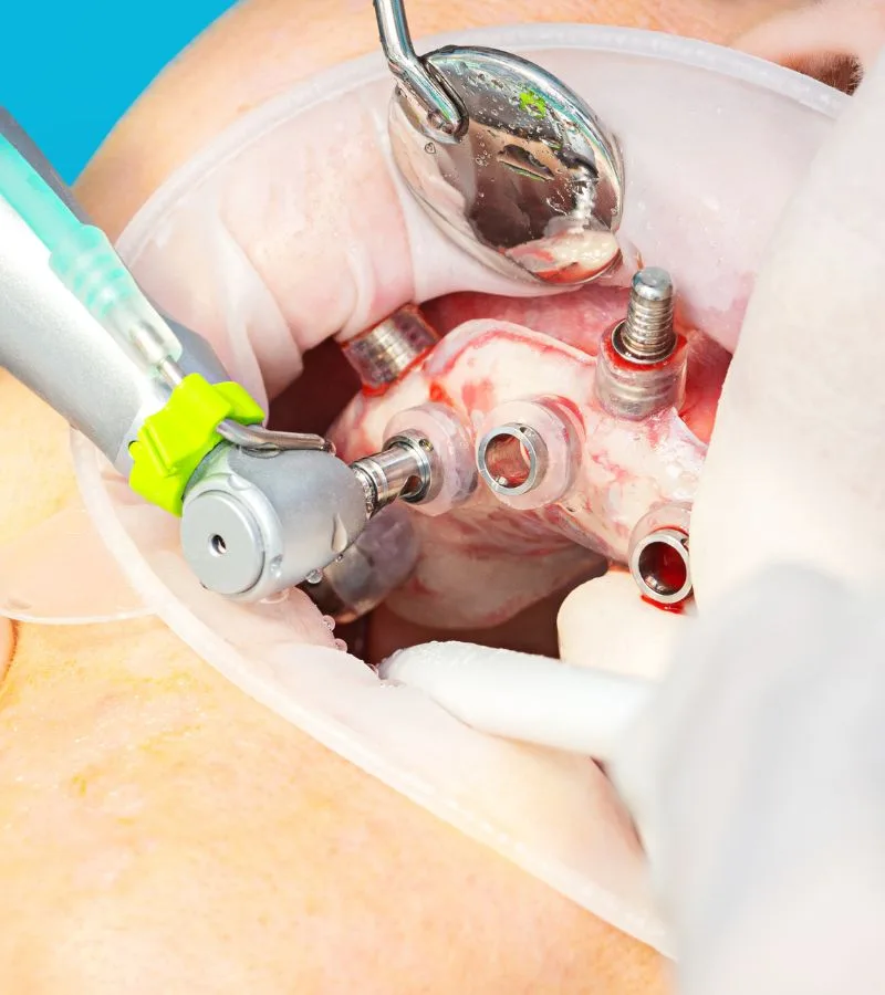 Guided surgery on dental implants