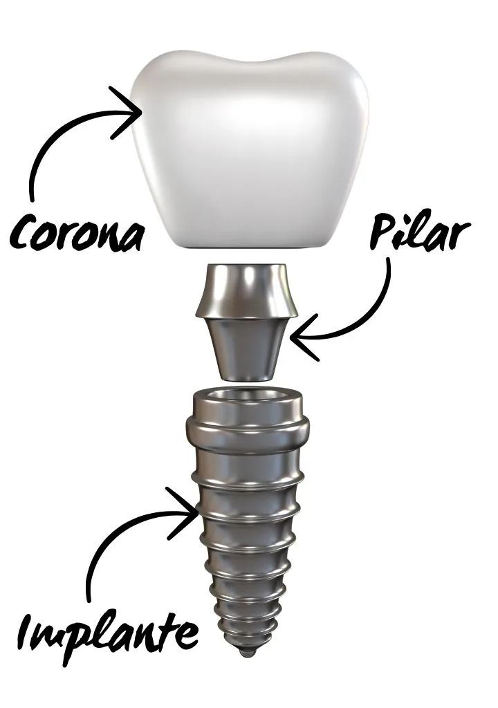 Parts of a dental implant