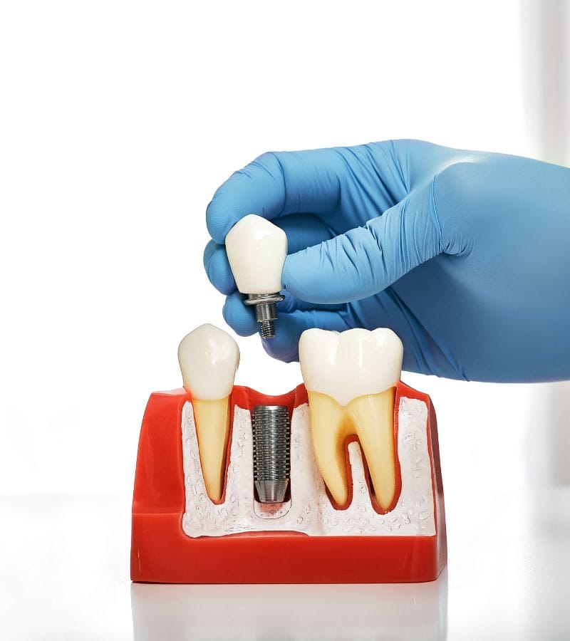 Tipos de implantes dentales Tipos de implantes dentales