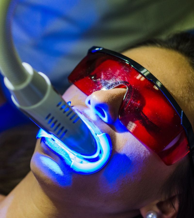 Blanqueamiento en clínica Blanqueamiento dental en Benidorm