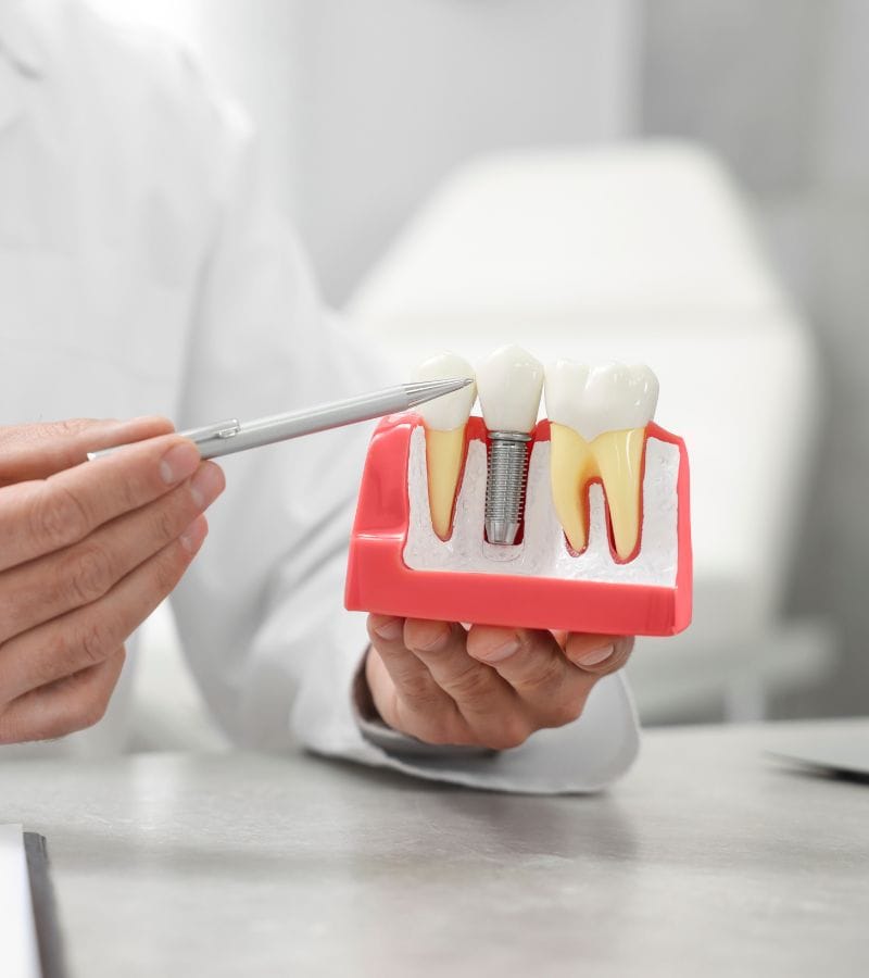 Rehabilitación dental Rehabilitación dental con coronas para bruxistas