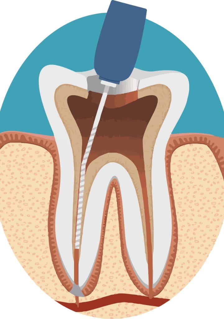 endodoncia Endodoncia en Benidorm