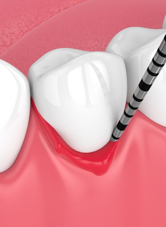 periodoncia benidorm Periodoncia en Benidorm