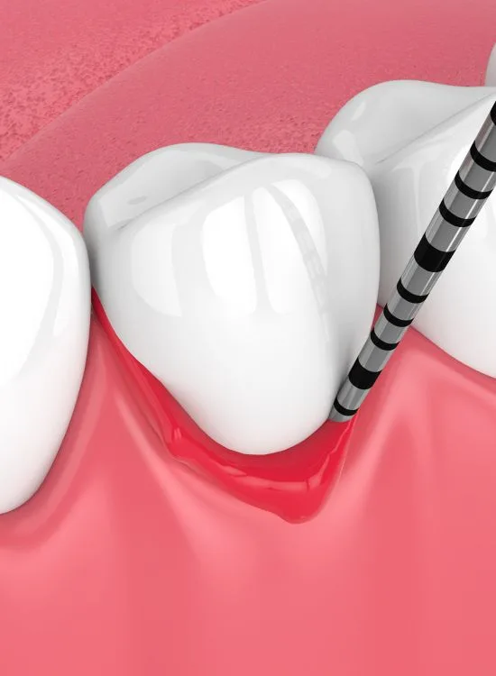periodoncia benidorm Periodoncia en Benidorm